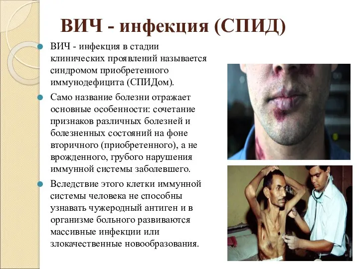 ВИЧ - инфекция (СПИД) ВИЧ - инфекция в стадии клинических проявлений называется