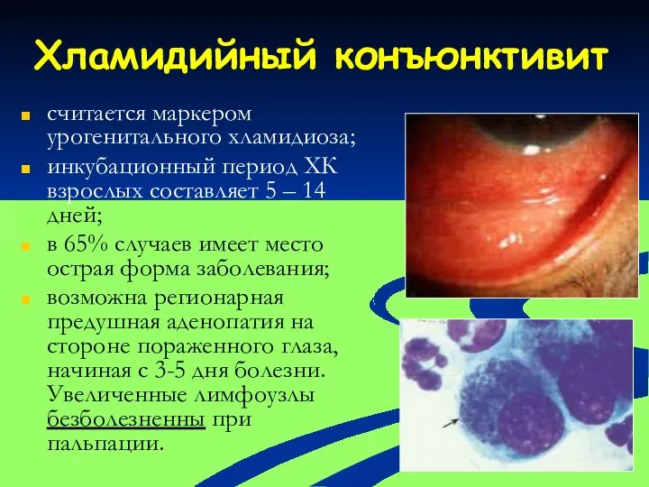 Хламидийный конъюнктивит считается маркером урогенитального хламидиоза; инкубационный период ХК взрослых составляет 5