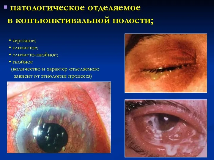 патологическое отделяемое в конъюнктивальной полости; серозное; слизистое; слизисто-гнойное; гнойное (количество и характер
