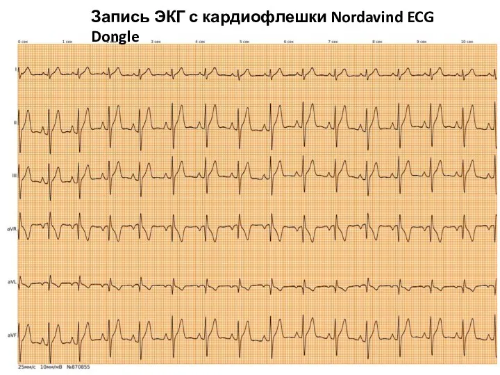 Запись ЭКГ с кардиофлешки Nordavind ECG Dongle