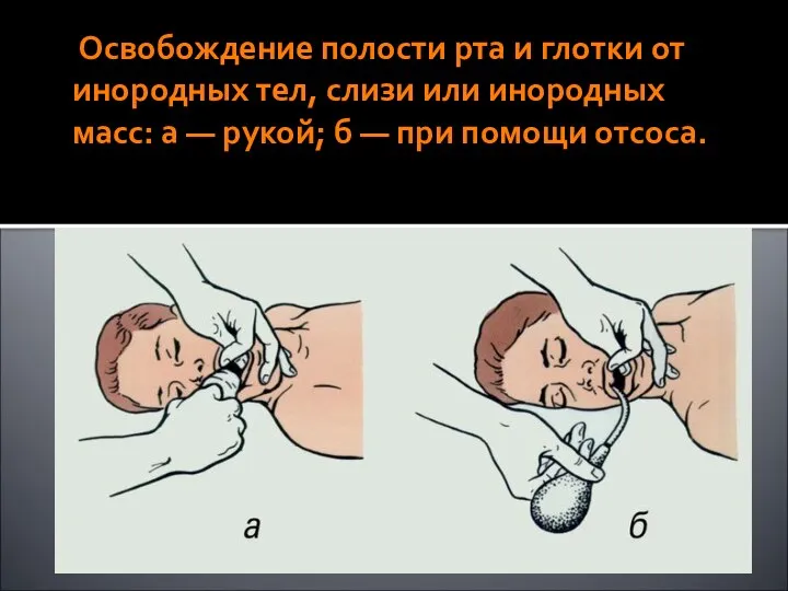 Освобождение полости рта и глотки от инородных тел, слизи или инородных масс: