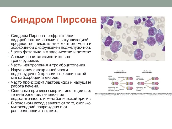 Синдром Пирсона Синдром Пирсона- рефрактерная сидеробластная анемия с вакуолизацией предшественников клеток костного