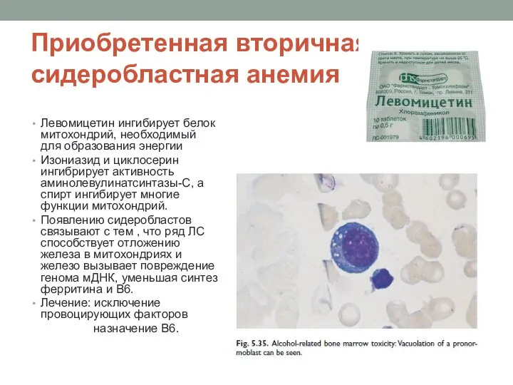 Приобретенная вторичная сидеробластная анемия Левомицетин ингибирует белок митохондрий, необходимый для образования энергии