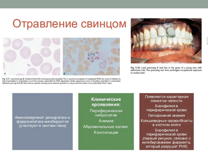 Отравление свинцом