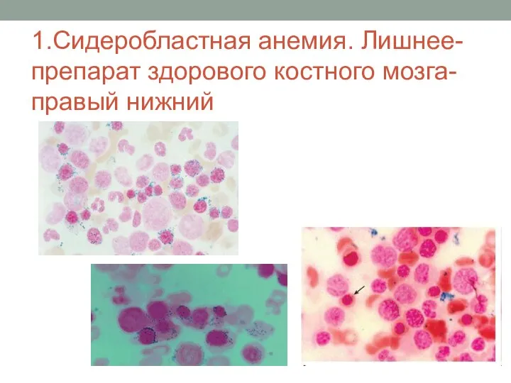 1.Сидеробластная анемия. Лишнее-препарат здорового костного мозга- правый нижний