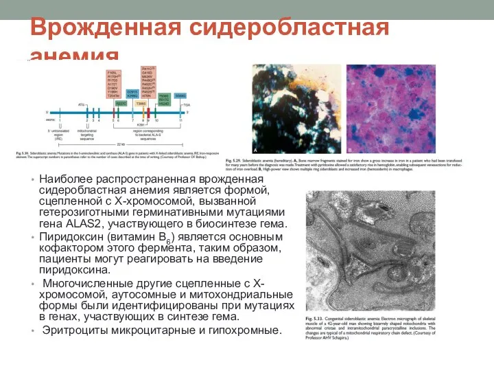 Врожденная сидеробластная анемия Наиболее распространенная врожденная сидеробластная анемия является формой, сцепленной с