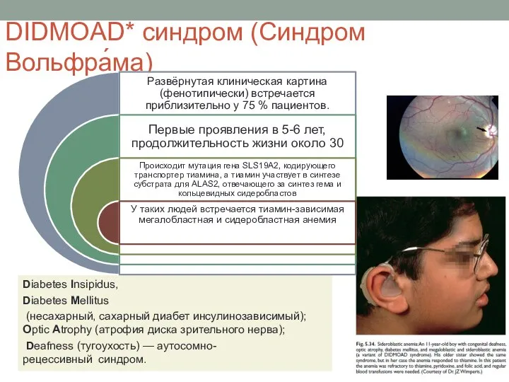 DIDMOAD* синдром (Синдром Вольфра́ма) Diabetes Insipidus, Diabetes Mellitus (несахарный, сахарный диабет инсулинозависимый);