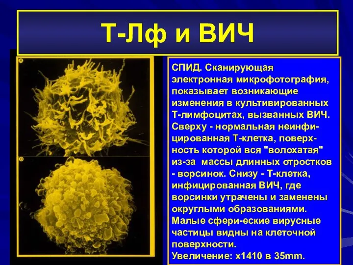 СПИД. Cканирующая электронная микрофотография, показывает возникающие изменения в культивированных Т-лимфоцитах, вызванных ВИЧ.