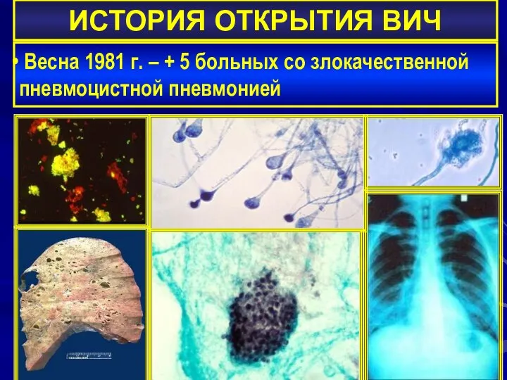 ИСТОРИЯ ОТКРЫТИЯ ВИЧ Весна 1981 г. – + 5 больных со злокачественной пневмоцистной пневмонией