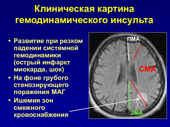 Развитие при резком падении системной гемодинамики (острый инфаркт миокарда, шок) На фоне