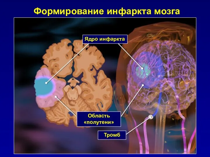 Формирование инфаркта мозга Ядро инфаркта Область «полутени» Тромб