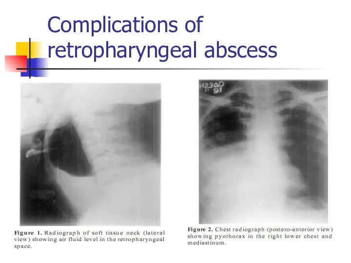 Complications of retropharyngeal abscess