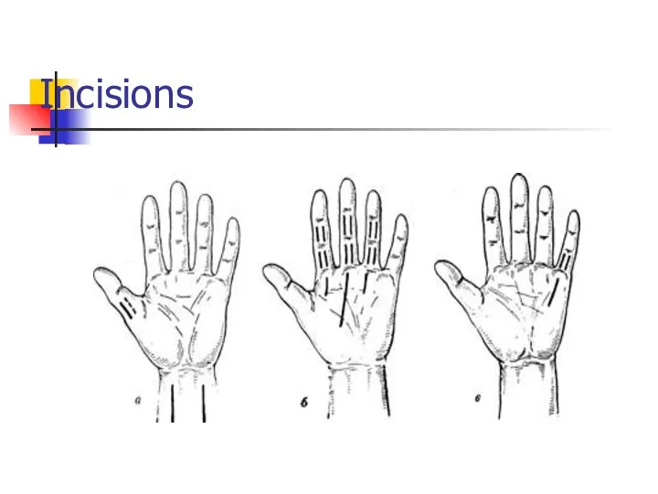 Incisions