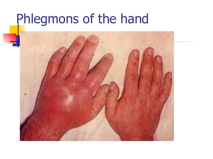 Phlegmons of the hand