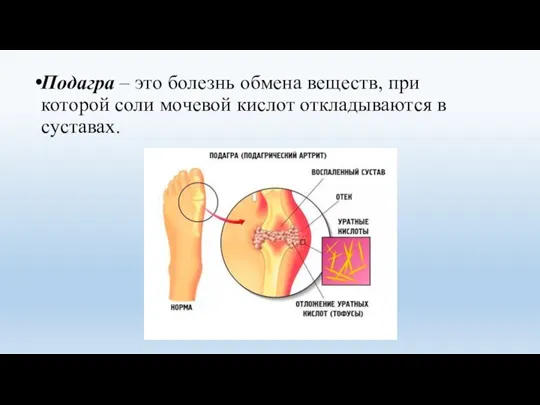 Подагра – это болезнь обмена веществ, при которой соли мочевой кислот откладываются в суставах.