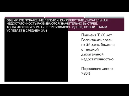 Пациент Т. 60 лет Госпитализирован на 5й день болезни с тяжелой дыхательной