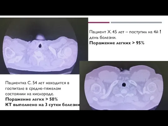 Пациент Х. 45 лет – поступил на 4й ! день болезни. Поражение