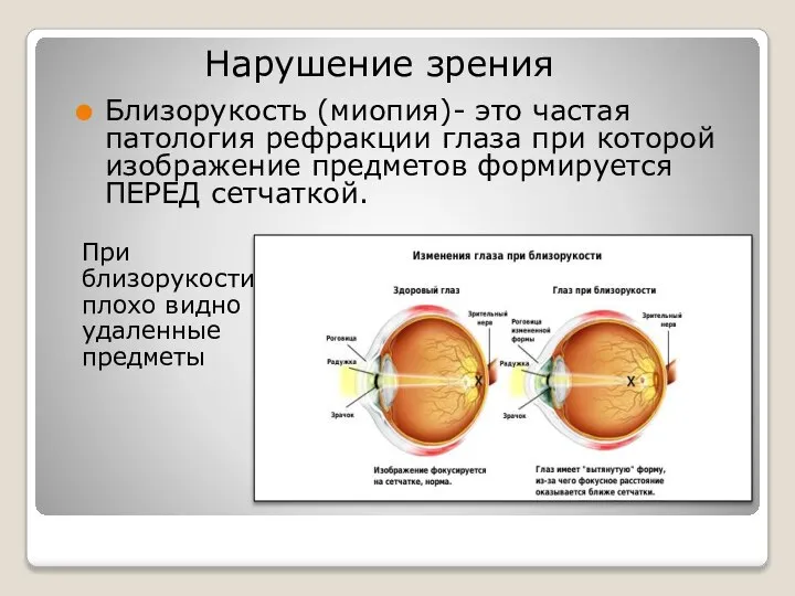 Близорукость (миопия)- это частая патология рефракции глаза при которой изображение предметов формируется