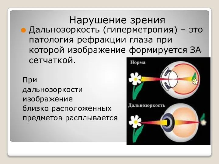 Дальнозоркость (гиперметропия) – это патология рефракции глаза при которой изображение формируется ЗА