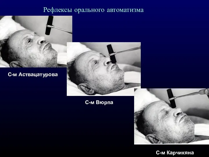 Рефлексы орального автоматизма С-м Аствацатурова С-м Вюрпа С-м Карчикяна