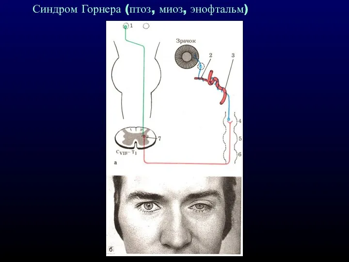 Синдром Горнера (птоз, миоз, энофтальм)