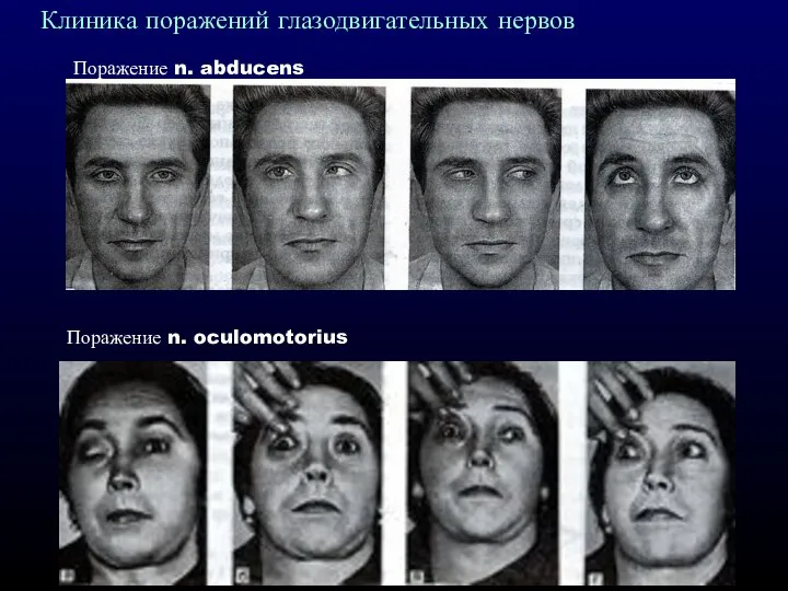 Поражение n. abducens Клиника поражений глазодвигательных нервов Поражение n. oculomotorius