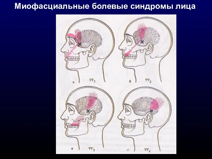 Миофасциальные болевые синдромы лица