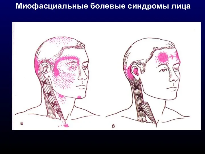 Миофасциальные болевые синдромы лица