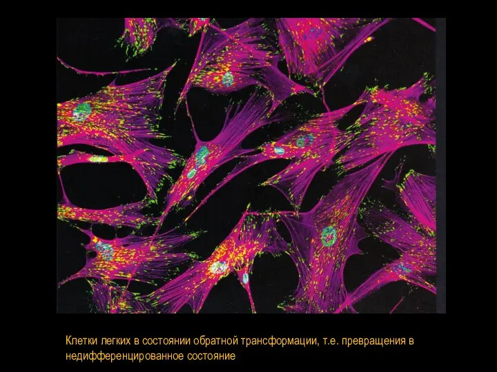 Клетки легких в состоянии обратной трансформации, т.е. превращения в недифференцированное состояние