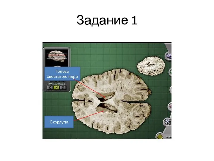 Задание 1 Голова хвостатого ядра Скорлупа