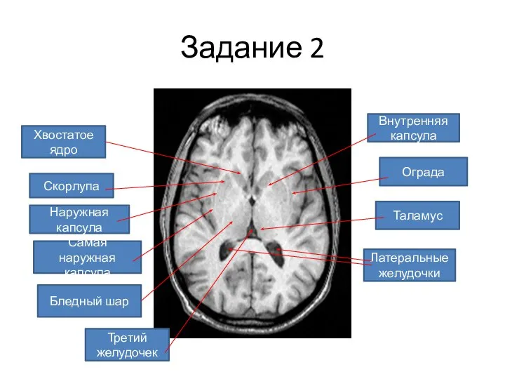 Задание 2 Хвостатое ядро Скорлупа Бледный шар Ограда Таламус Латеральные желудочки Третий