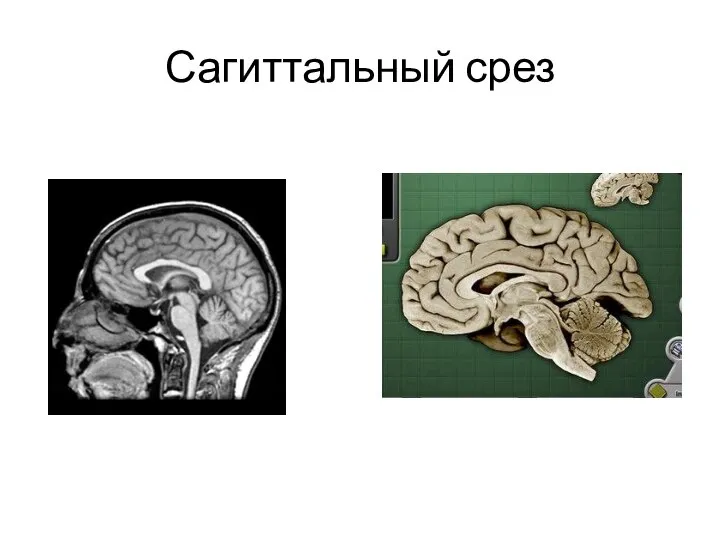 Сагиттальный срез