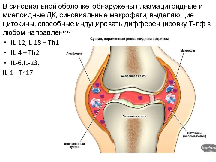 В синовиальной оболочке обнаружены плазмацитоидные и миелоидные ДК, синовиальные макрофаги, выделяющие цитокины,