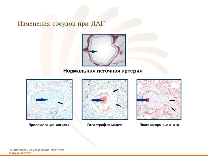 Изменения сосудов при ЛАГ По материалам и с разрешения Frazier et al. Radiographics 2000