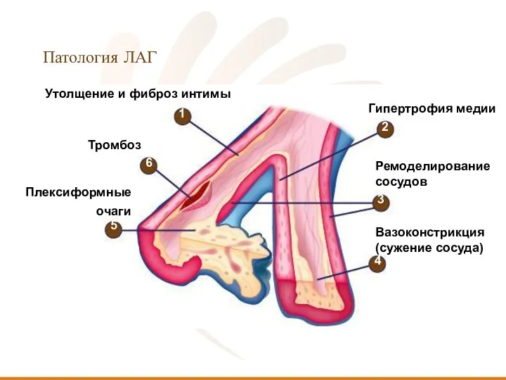 Патология ЛАГ Утолщение и фиброз интимы Тромбоз Плексиформные очаги Гипертрофия медии Ремоделирование