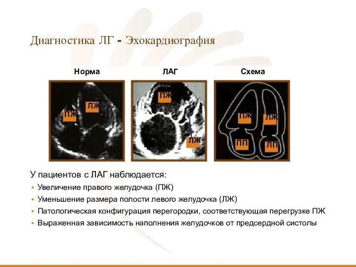 Диагностика ЛГ - Эхокардиография Схема ЛАГ Норма У пациентов с ЛАГ наблюдается: