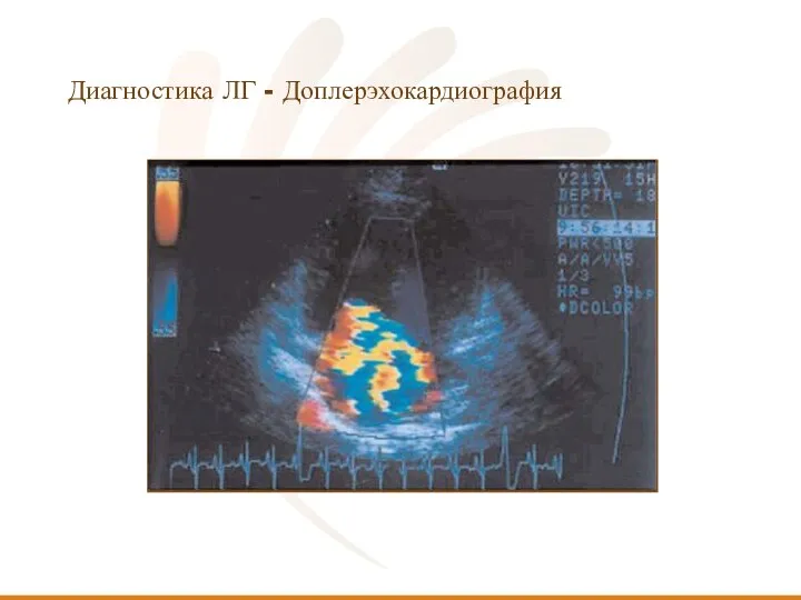 Диагностика ЛГ - Доплерэхокардиография