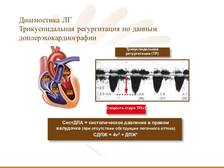 Диагностика ЛГ Трикуспидальная регургитация по данным доплерэхокардиографии Трикуспидальная регургитация (ТР) Скорость струи