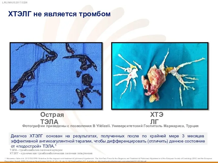 ХТЭЛГ Острая ТЭЛА ХТЭЛГ не является тромбом Фотографии приведены с позволения B