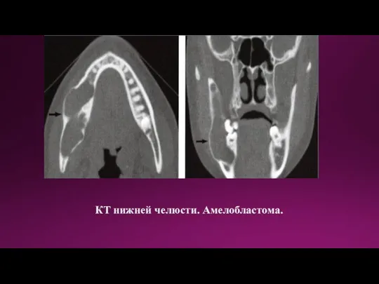 КТ нижней челюсти. Амелобластома.