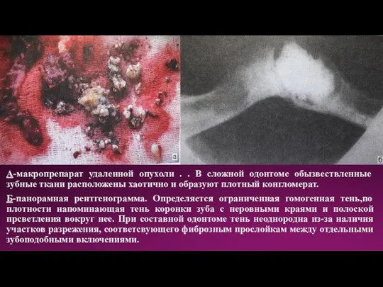 А-макропрепарат удаленной опухоли . . В сложной одонтоме обызвествленные зубные ткани расположены