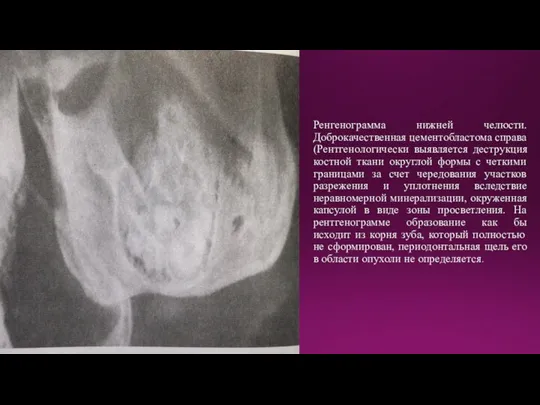 Ренгенограмма нижней челюсти. Доброкачественная цементобластома справа (Рентгенологически выявляется деструкция костной ткани округлой