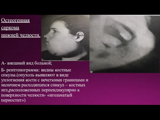 Остеогенная саркома нижней челюсти. А- внешний вид больной; Б- рентгенограмма: видны костные