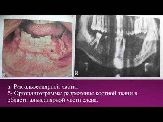 а- Рак альвеолярной части; б- Ортопантограмма: разрежение костной ткани в области альвеолярной части слева.