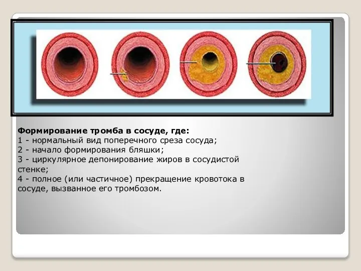 Формирование тромба в сосуде, где: 1 - нормальный вид поперечного среза сосуда;