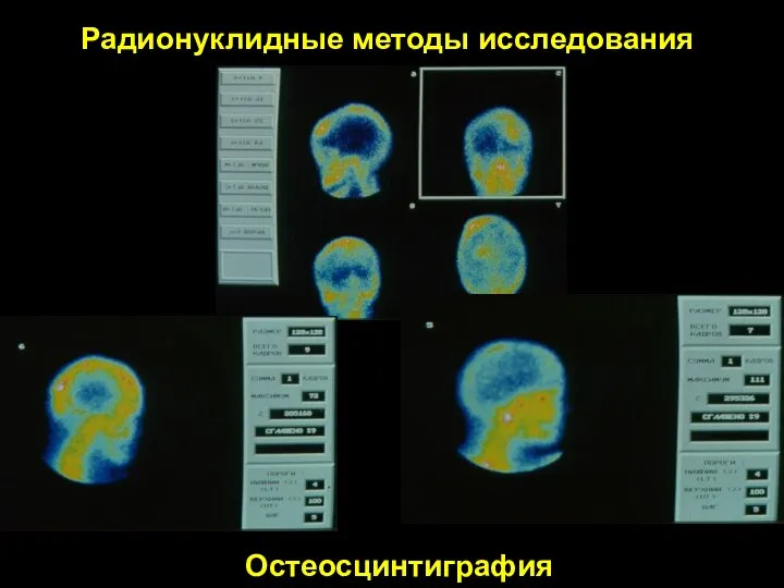 Остеосцинтиграфия Радионуклидные методы исследования