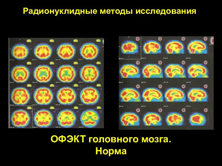 ОФЭКТ головного мозга. Норма Радионуклидные методы исследования