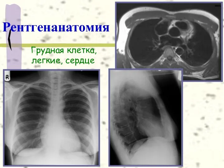 Рентгенанатомия Грудная клетка, легкие, сердце