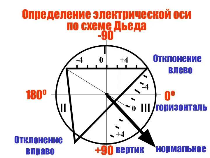 Определение электрической оси по схеме Дьеда I II III -4 0 +4