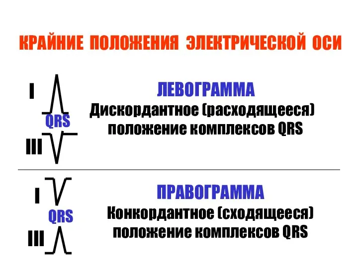 КРАЙНИЕ ПОЛОЖЕНИЯ ЭЛЕКТРИЧЕСКОЙ ОСИ QRS I III QRS I III ЛЕВОГРАММА Дискордантное